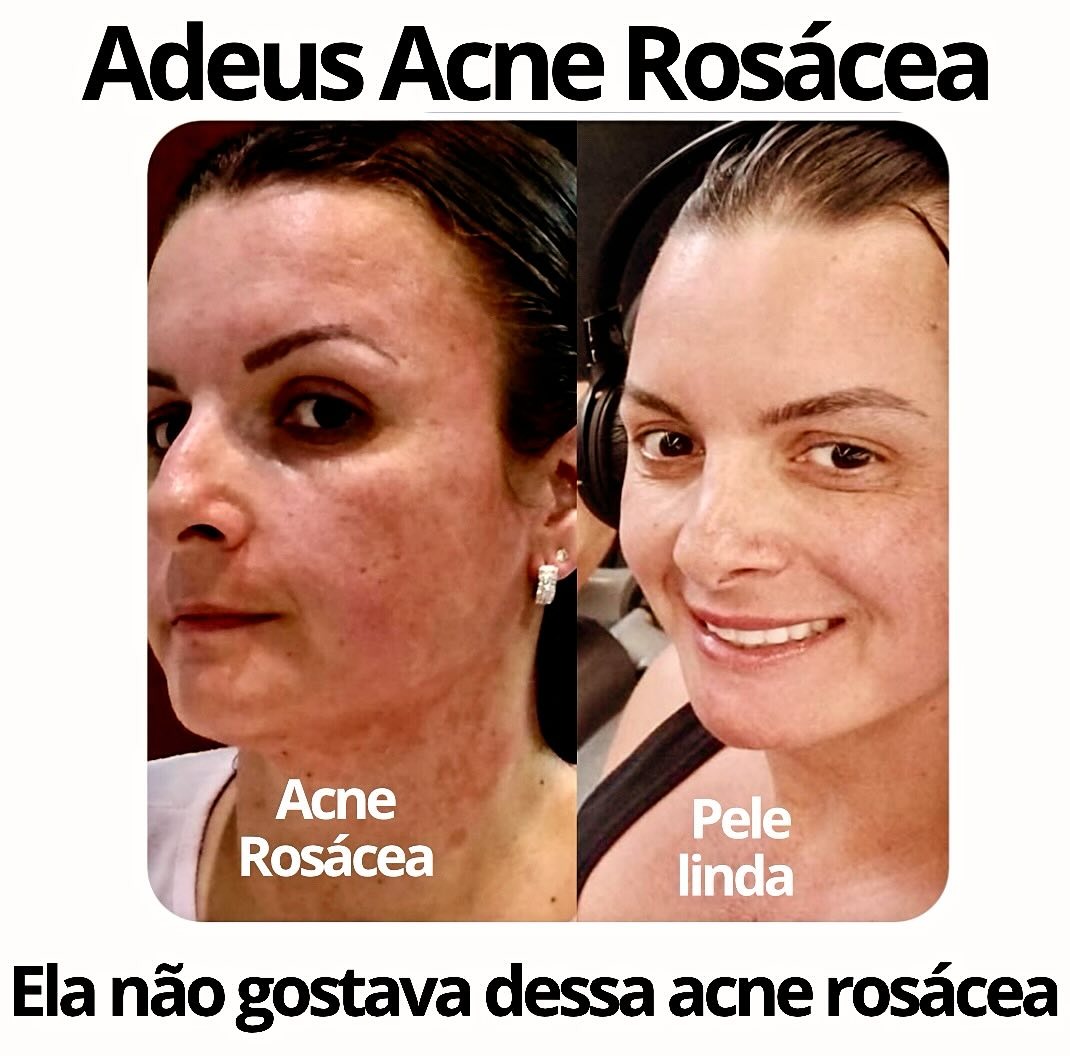 rosacea
